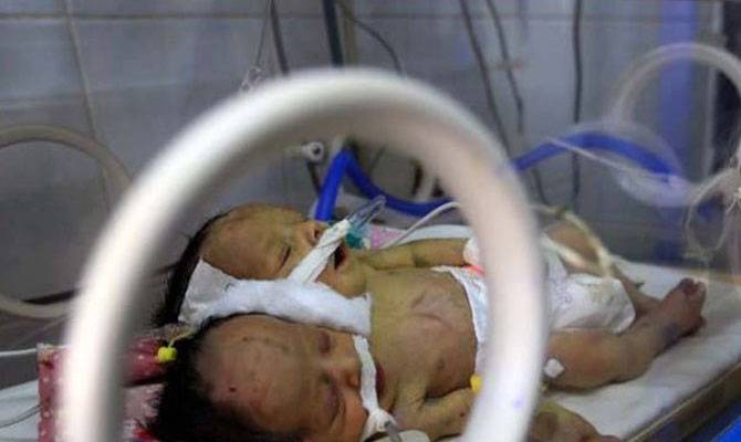  دو دھڑ جڑی بچیوں کی پیدائش ، رپورٹ کے بعد علاج کا فیصلہ