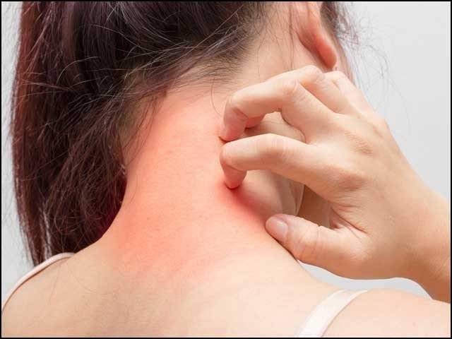 جسم،گرمی دانے ، علامت،کورونا وائرس ، اومی کرون ویرئینٹ