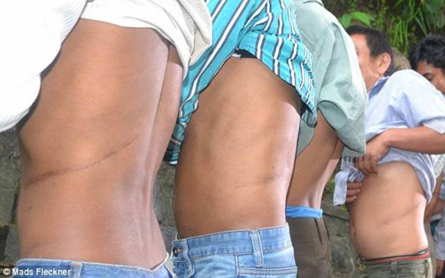 بہاولنگر: فورٹ عباس میں 3 مزدوروں کے گُردے نکال لیے گئے، واقعے کا مقدمہ درج