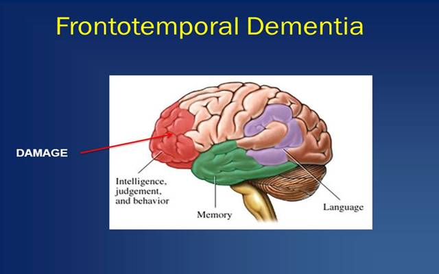 ) فرنٹو ٹیمپورل ڈیمنشیا (ایف ٹی ڈی) ایک لاعلاج بیماری ہے جو دماغ کے فرنٹل اور ٹیمپورل لوبز میں اعصابی خلیات کی مسلسل کمی سے ہوتی ہے