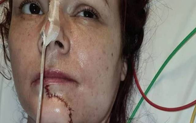  ایک برطانوی خاتون نے اس وقت ڈاکٹروں کو حیران کر دیا جب وہ 90 فی صد زبان کٹنے کے بعد بھی باتیں کرنے لگی۔