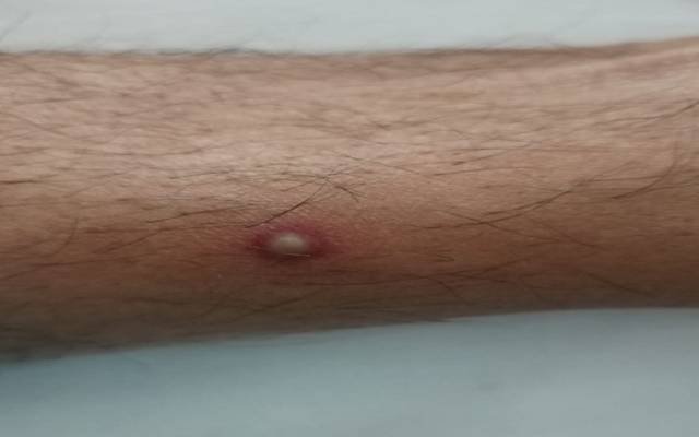 پاکستان میں منکی پاکس کا ایک ساتھ 2 کیسز سامنے آ گئے