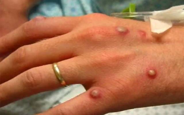 مونکی پاکس کے کیسز ، ضلعی انتظامیہ کا اہم فیصلہ 