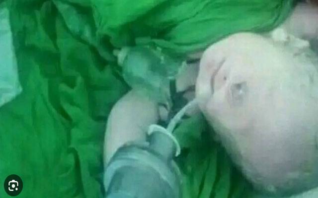 عراق میں ایک آنکھ والے بچے کی پیدائش