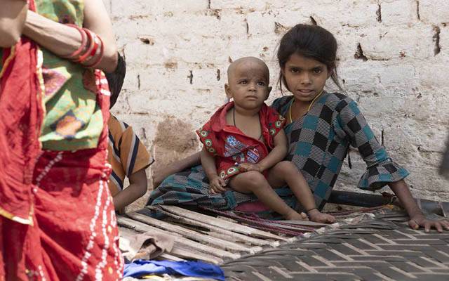 بھارت زیرو ڈوز بچوں کی تعداد کے لحاظ سے سرفہرست ہے، عالمی ادارہ صحت