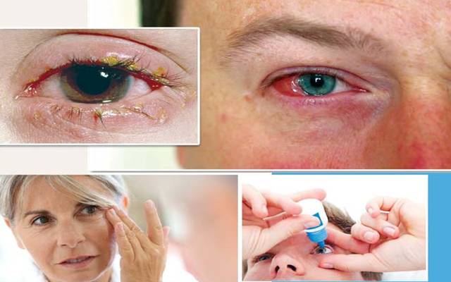  آشوب چشم کے مرض میں تیزی سے اضافہ ہونے لگا، ماہرین کے مطابق آنکھوں کا انفیکشن مزید ایک ماہ تک رہنے کا امکان ہے۔