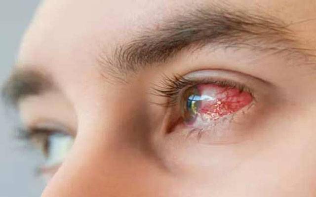 آشوب چشم سے متاثرہ مریضوں کی تعداد میں خطرناک حد تک اضافہ