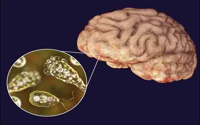 کراچی، دماغ خور جرثومہ ایک اور جان نگل گیا