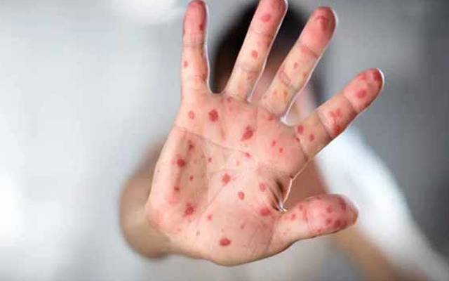 قمبر میں خطرناک مرض خناق سے 4 بچے جاں بحق 
