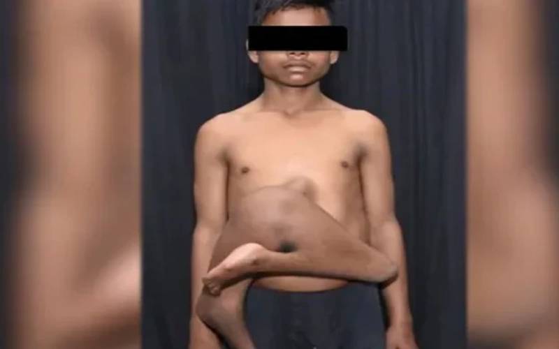 بھارت میں 4ٹانگوں والے لڑکا کا کامیاب آپریشن