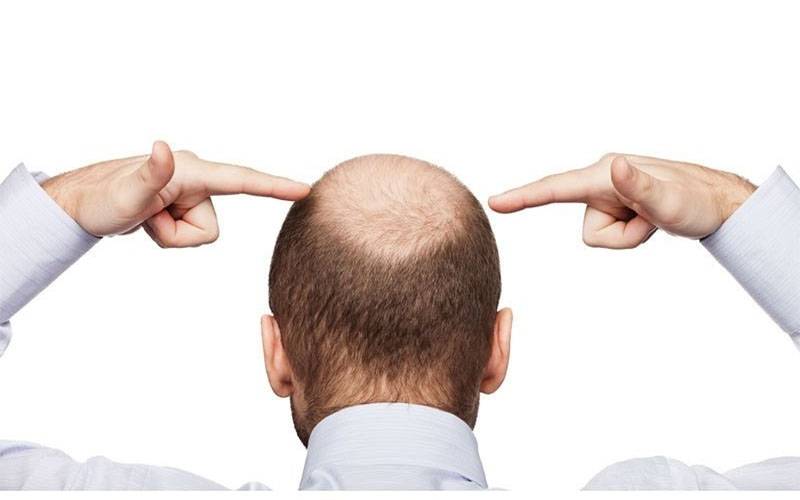 گنج پن کو دور کرنے کیلئے کیسٹر آئل کو استعمال کرنے کا صحیح طریقہ کیا ہے؟  