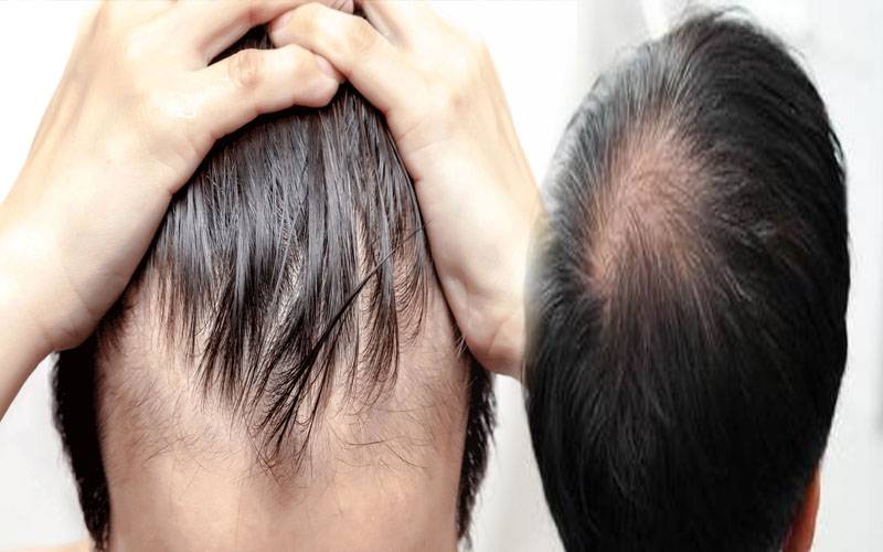 کتنے فیصد پاکستانی گنج پن میں مبتلا، مرد اور خواتین میں کون زیادہ شکار؟
