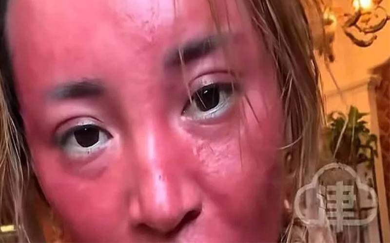 دو دہائیوں سےمیک اپ نہ صاف کرنیوالی خاتون کا چہرہ لال بندر کی طرح ہوگیا