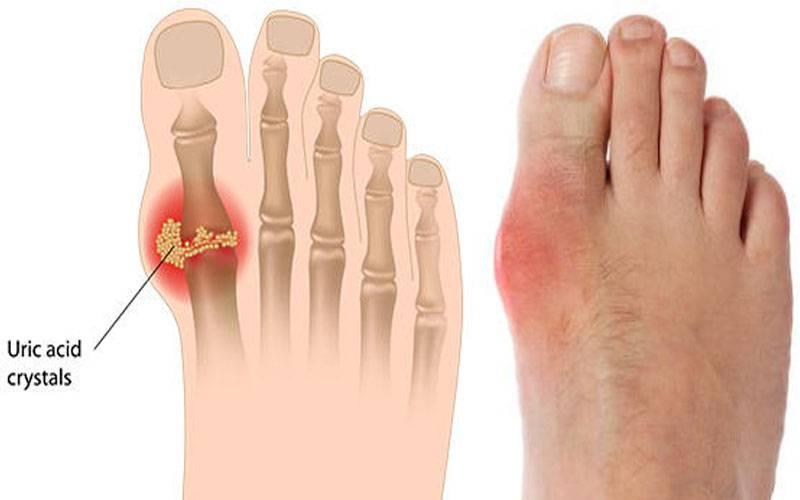  دل کی صحت کے خاموش دشمن یورک ایسڈ سے کیسے بچا جائے؟
