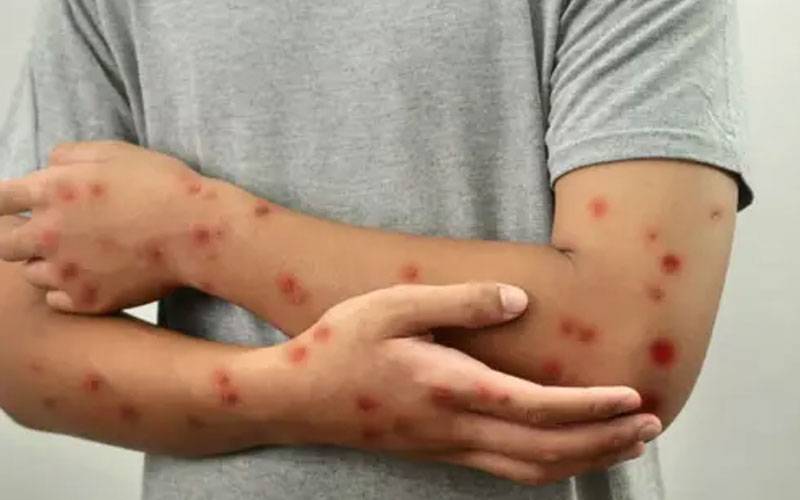  لاہور میں منکی پاکس کے 4 نئے مریضوں کی تصدیق