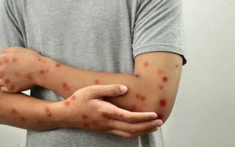 کراچی میں منکی پاکس کا ایک اور کیس سامنے اگیا