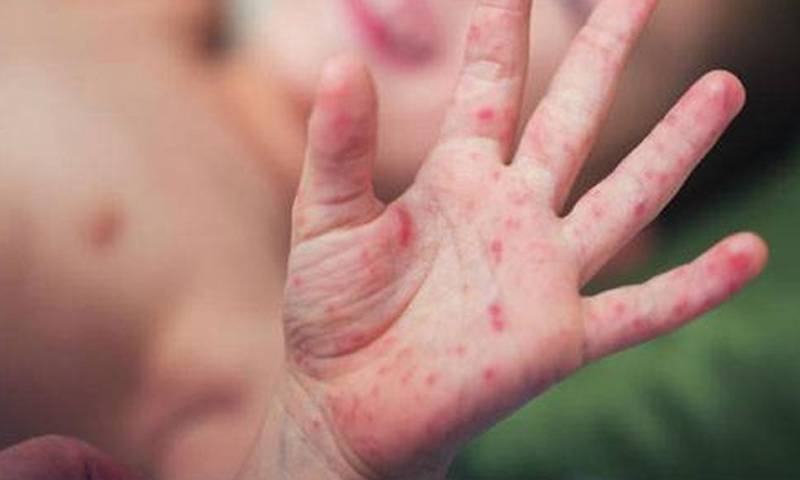 سندھ میں خسرہ نے ایک بارپھر وبائی صورت اختیار کرلی