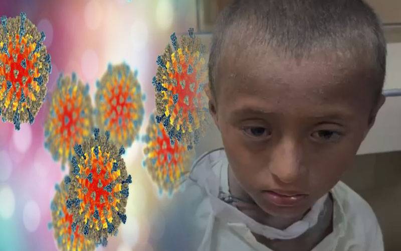 خانیوال میں ایک ہی خاندان کے8بچے خسرہ کی بیماری میں مبتلا،3 بچے جاں بحق،5ہسپتال منتقل